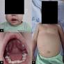 Simultaneous Maxillofacial, Abdominal, and Bone Marrow Involvement in a Pediatric Patient With Epstein-Barr Virus-Associated Burkitt Lymphoma: A Case From India